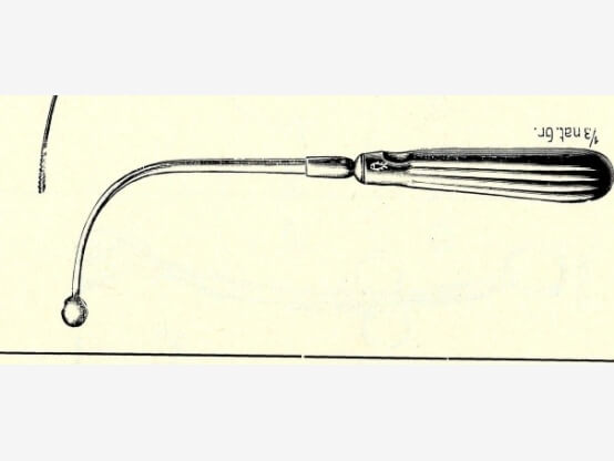 Die funktionelle psychogene Aphonie, Der Trick mit der „Muckschen Kugel“