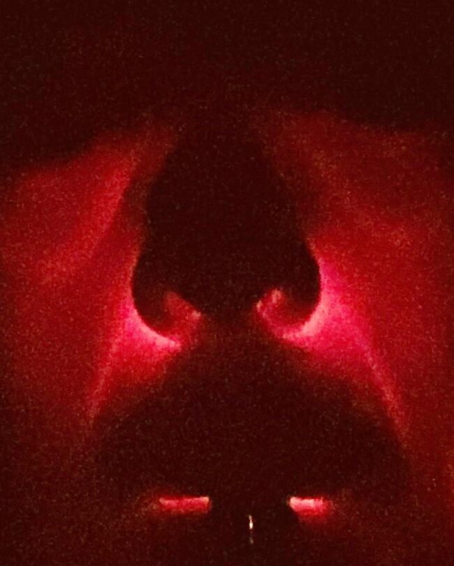 Die Diaphnoskopie der Nasennebenhöhlen