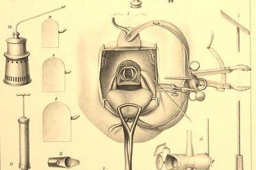 Victor von Bruns und seine erste Stimmbandpolypenoperation