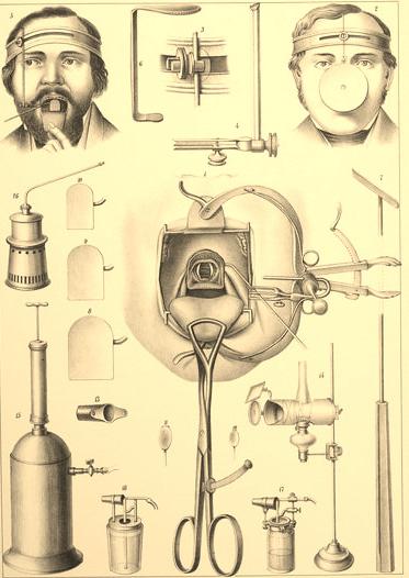 Victor von Bruns und seine erste Stimmbandpolypenoperation